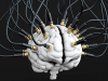 Стимуляция мозга с помощью электродов-имплантов – для терапии психических расстройств