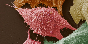 Раковые клетки – «любители» и расточители глюкозы