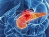 «Высокий» инсулин увеличивает риск рака поджелудочной железы 