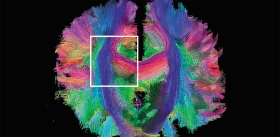 Черепно-мозговая травма меняет работу всего мозга