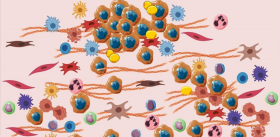 «Проводниками» для метастазов при раке яичников служат здоровые клетки брюшной полости